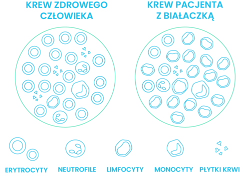 przewlekła białaczka limfocytowa