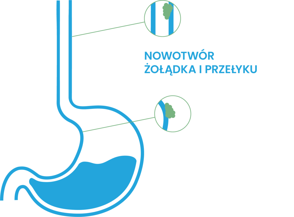 Rak żołądka i przełyku