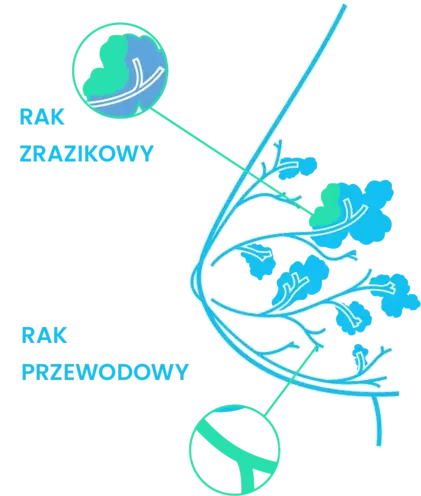 rak piersi