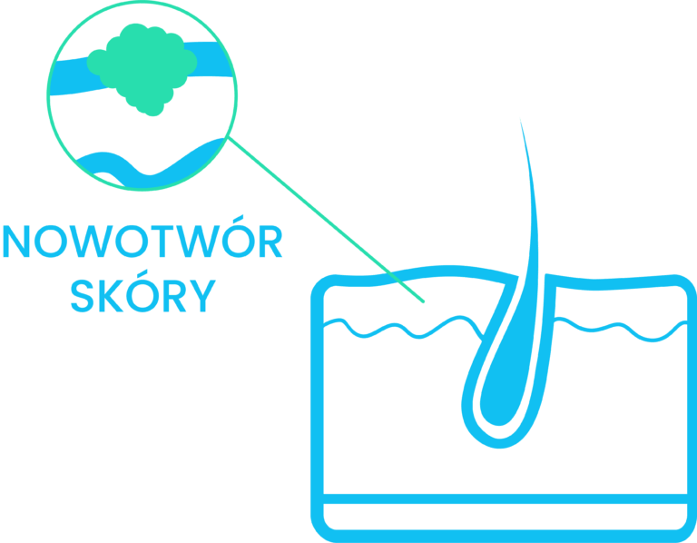 rak skóry