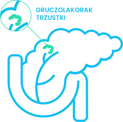 rak trzustki