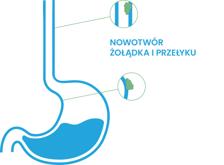 rak zoladka i przelyku
