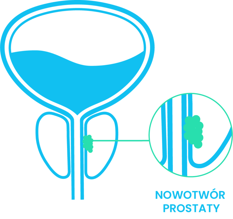 nowotwor prostaty