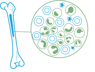 ostra białaczka szpikowa