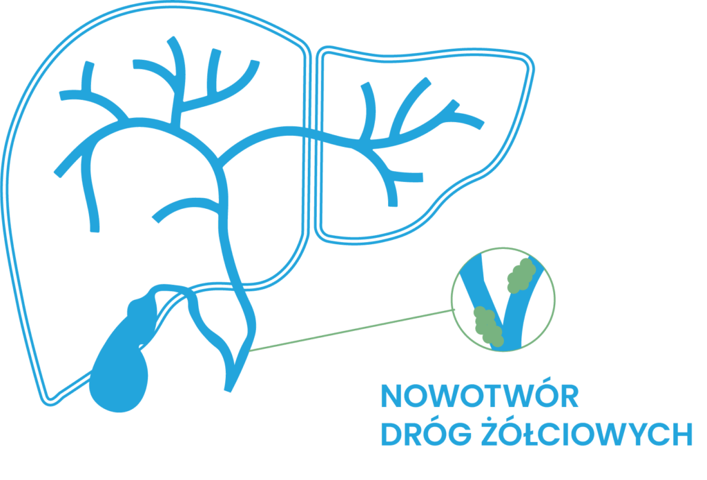 Rak dróg żółciowych