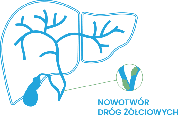 rak drog zolciowych