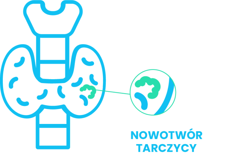 rak tarczycy